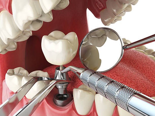 Best Broken or Cracked Tooth Emergency Dentist in Jessup, PA